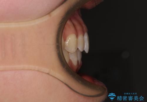 【モニター】隠れている下顎の前歯をインビザラインで改善の治療後