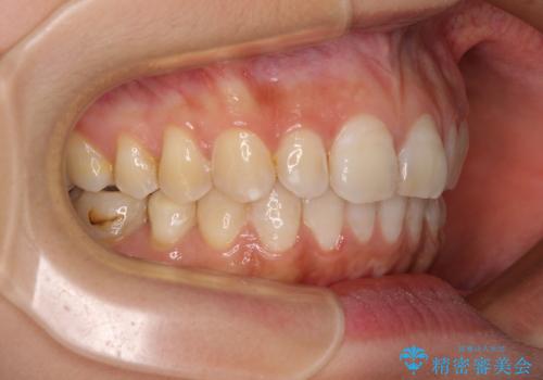 【モニター】隠れている下顎の前歯をインビザラインで改善の治療後