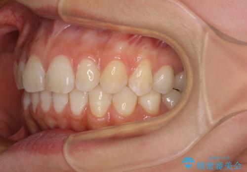 【モニター】隠れている下顎の前歯をインビザラインで改善の治療後