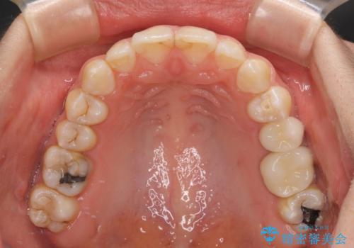 【モニター】隠れている下顎の前歯をインビザラインで改善の治療後