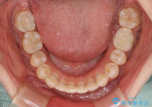 【モニター】隠れている下顎の前歯をインビザラインで改善の治療後