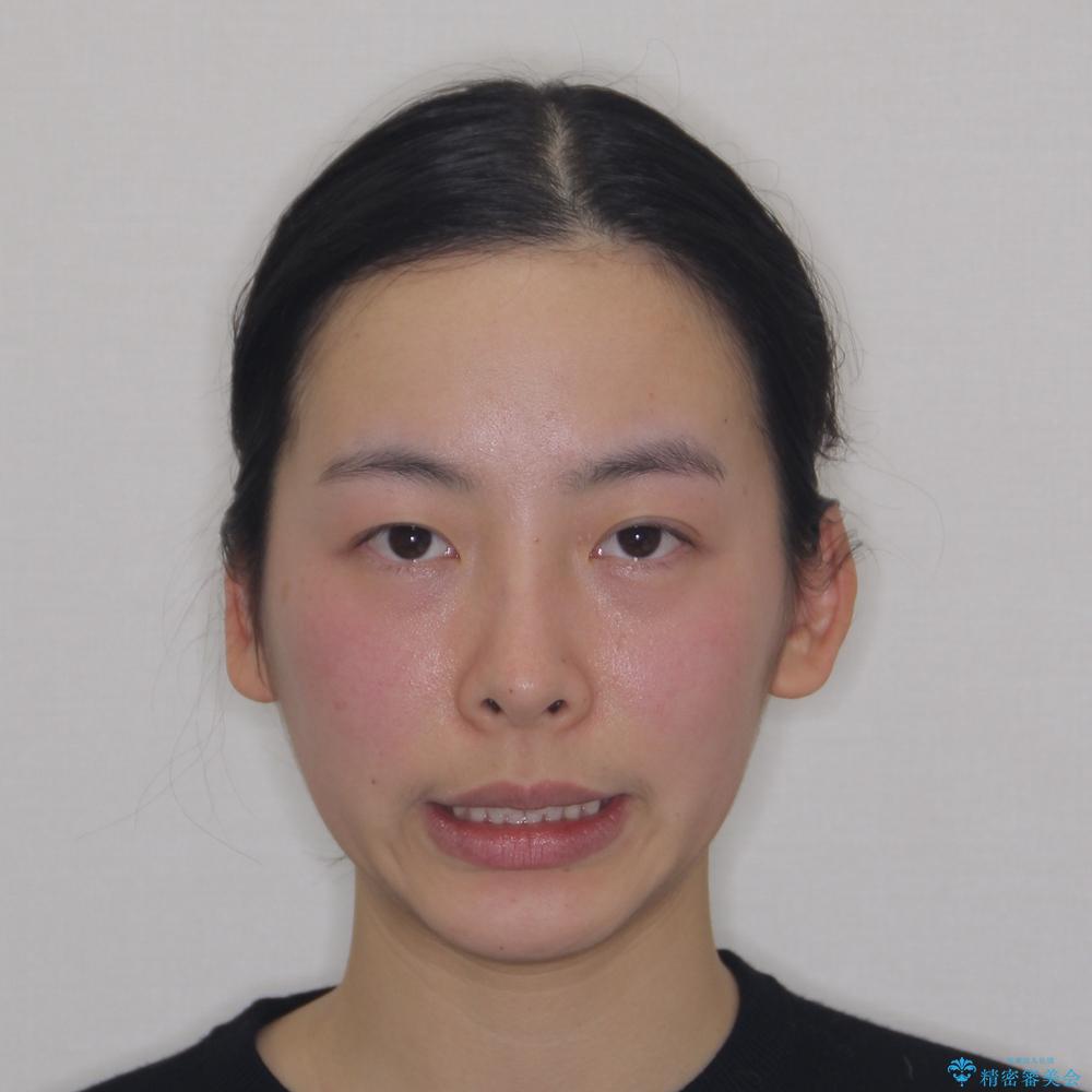 【モニター】隠れている下顎の前歯をインビザラインで改善の治療後(顔貌)