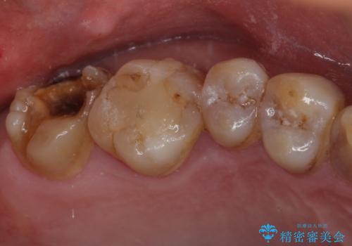 虫歯で銀歯が外れた ゴールドインレーによる虫歯治療の治療前