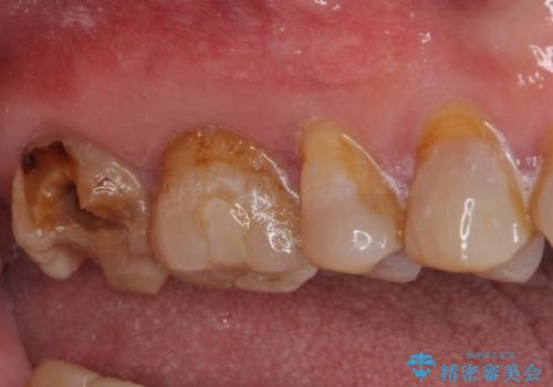 虫歯で銀歯が外れた　ゴールドインレーによる虫歯治療の治療前