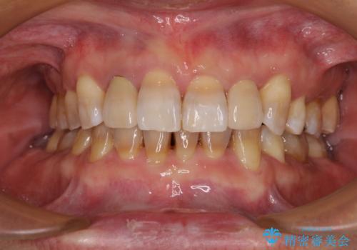 左右に骨格がずれて咬みにくい ワイヤー装置による抜歯矯正の症例 治療後