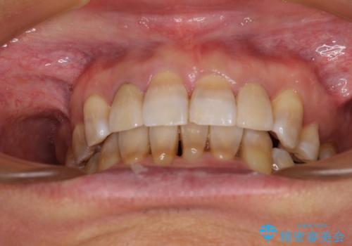 左右に骨格がずれて咬みにくい ワイヤー装置による抜歯矯正の治療後