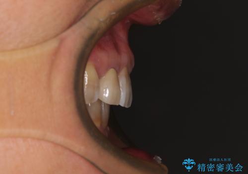 左右に骨格がずれて咬みにくい ワイヤー装置による抜歯矯正の治療後