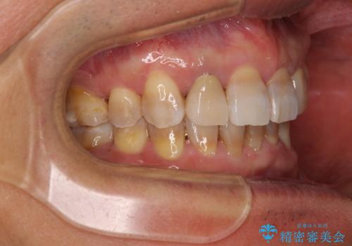 左右に骨格がずれて咬みにくい ワイヤー装置による抜歯矯正の治療後