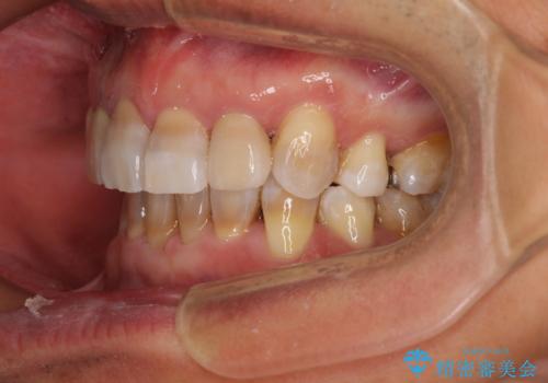 左右に骨格がずれて咬みにくい ワイヤー装置による抜歯矯正の治療後