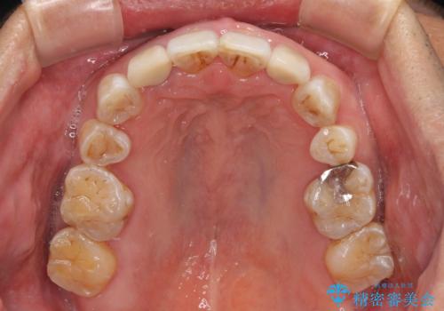 左右に骨格がずれて咬みにくい ワイヤー装置による抜歯矯正の治療後