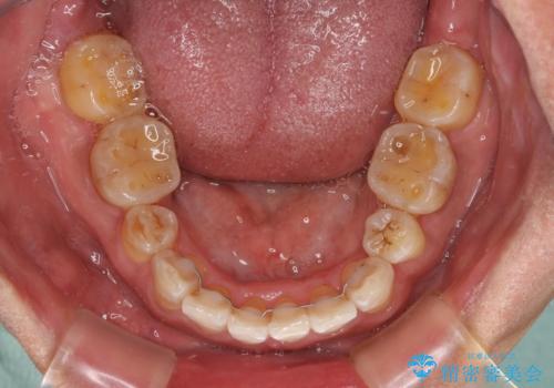 左右に骨格がずれて咬みにくい ワイヤー装置による抜歯矯正の治療後