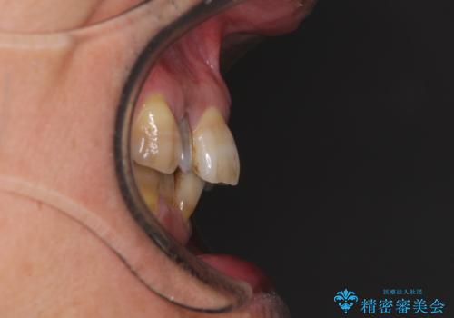 左右に骨格がずれて咬みにくい　ワイヤー装置による抜歯矯正の治療前
