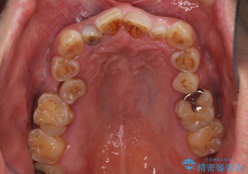 左右に骨格がずれて咬みにくい ワイヤー装置による抜歯矯正の治療前