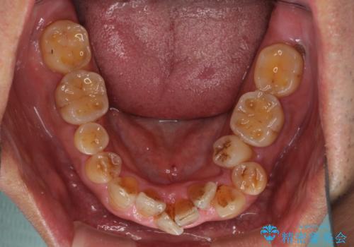 左右に骨格がずれて咬みにくい ワイヤー装置による抜歯矯正の治療前