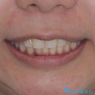 深い咬み合わせと前歯のデコボコ　インビザラインによる矯正治療の治療後（顔貌）