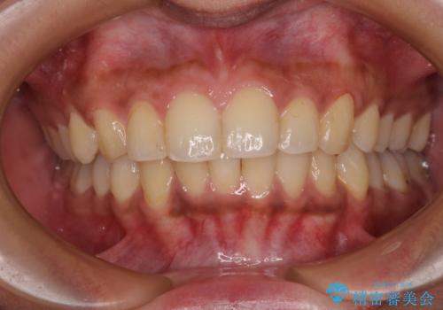 深い咬み合わせと前歯のデコボコ　インビザラインによる矯正治療の症例 治療後