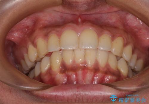 深い咬み合わせと前歯のデコボコ　インビザラインによる矯正治療の治療後