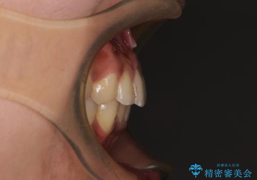 深い咬み合わせと前歯のデコボコ インビザラインによる矯正治療の治療後