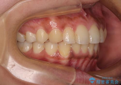 深い咬み合わせと前歯のデコボコ インビザラインによる矯正治療の治療後