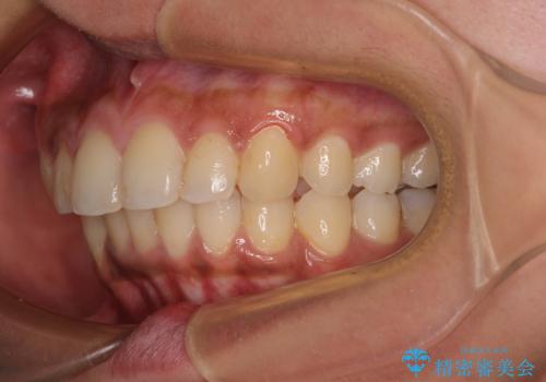 深い咬み合わせと前歯のデコボコ インビザラインによる矯正治療の治療後