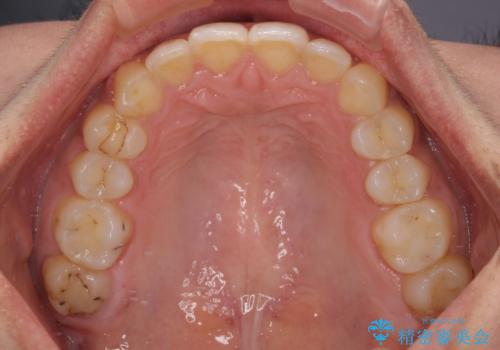 深い咬み合わせと前歯のデコボコ インビザラインによる矯正治療の治療後