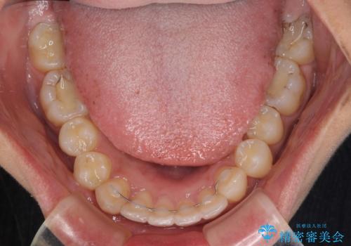 深い咬み合わせと前歯のデコボコ　インビザラインによる矯正治療の治療後