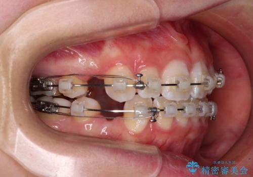 【モニター】口が閉じにくい 膨らんだ口元を抜歯矯正ですっきりとの治療中