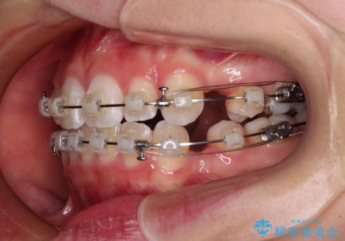 【モニター】口が閉じにくい 膨らんだ口元を抜歯矯正ですっきりとの治療中