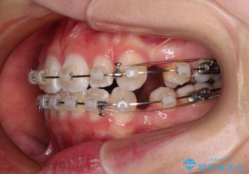 【モニター】口が閉じにくい　膨らんだ口元を抜歯矯正ですっきりとの治療中