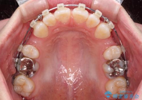 【モニター】口が閉じにくい 膨らんだ口元を抜歯矯正ですっきりとの治療中