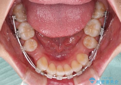 【モニター】口が閉じにくい 膨らんだ口元を抜歯矯正ですっきりとの治療中