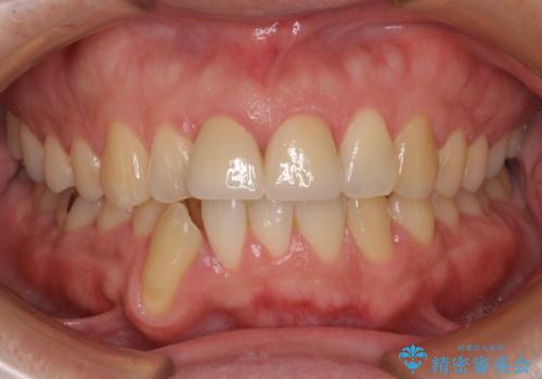 転んで欠けてしまった前歯 抜歯を回避してオールセラミッククラウンで審美回復の治療後