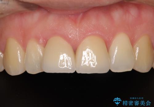 転んで欠けてしまった前歯 抜歯を回避してオールセラミッククラウンで審美回復の治療後