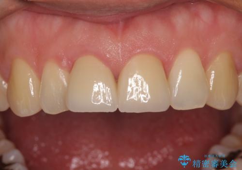 転んで欠けてしまった前歯 抜歯を回避してオールセラミッククラウンで審美回復の治療後