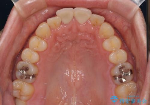 転んで欠けてしまった前歯 抜歯を回避してオールセラミッククラウンで審美回復の治療後