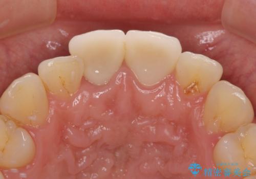 転んで欠けてしまった前歯 抜歯を回避してオールセラミッククラウンで審美回復の治療後