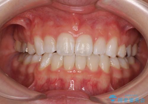 【モニター】口が閉じにくい 膨らんだ口元を抜歯矯正ですっきりとの治療後