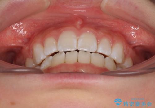 【モニター】口が閉じにくい 膨らんだ口元を抜歯矯正ですっきりとの治療後