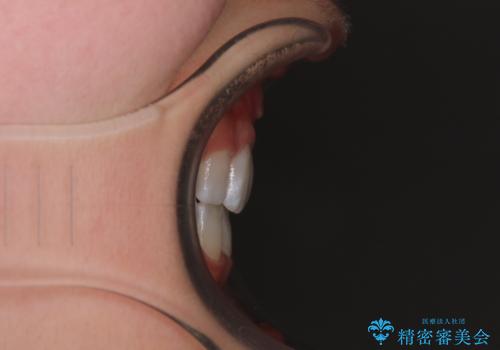 【モニター】口が閉じにくい 膨らんだ口元を抜歯矯正ですっきりとの治療後