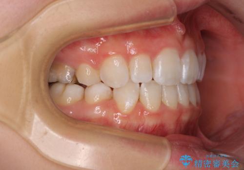 【モニター】口が閉じにくい 膨らんだ口元を抜歯矯正ですっきりとの治療後