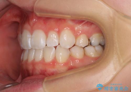 【モニター】口が閉じにくい 膨らんだ口元を抜歯矯正ですっきりとの治療後