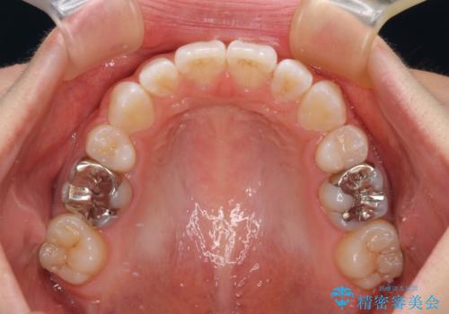 【モニター】口が閉じにくい 膨らんだ口元を抜歯矯正ですっきりとの治療後