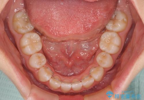 【モニター】口が閉じにくい 膨らんだ口元を抜歯矯正ですっきりとの治療後