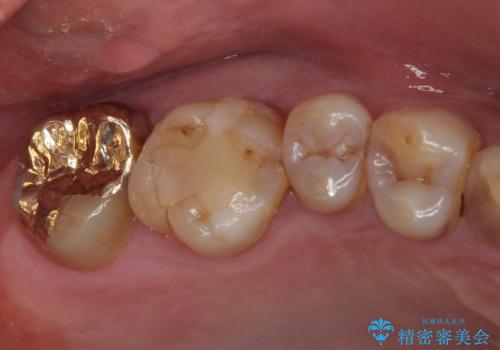 虫歯で銀歯が外れた　ゴールドインレーによる虫歯治療の症例 治療後