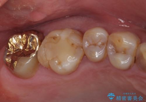 虫歯で銀歯が外れた　ゴールドインレーによる虫歯治療