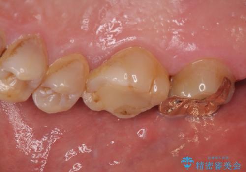 虫歯で銀歯が外れた ゴールドインレーによる虫歯治療の治療後