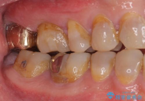 虫歯で銀歯が外れた　ゴールドインレーによる虫歯治療の治療後