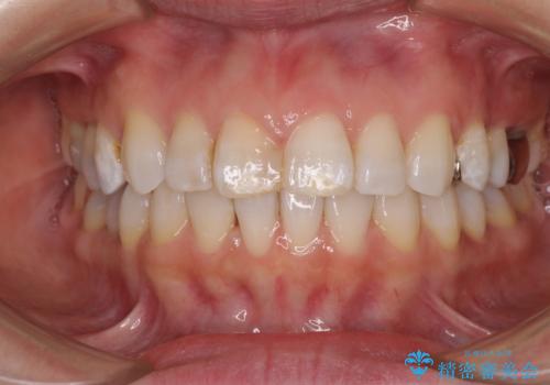 【モニター】前歯のデコボコを治したい インビザラインを用いた矯正治療の症例 治療後