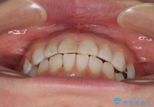 【モニター】前歯のデコボコを治したい インビザラインを用いた矯正治療の治療後