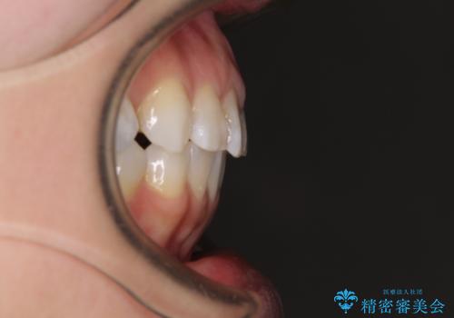 【モニター】前歯のデコボコを治したい インビザラインを用いた矯正治療の治療後